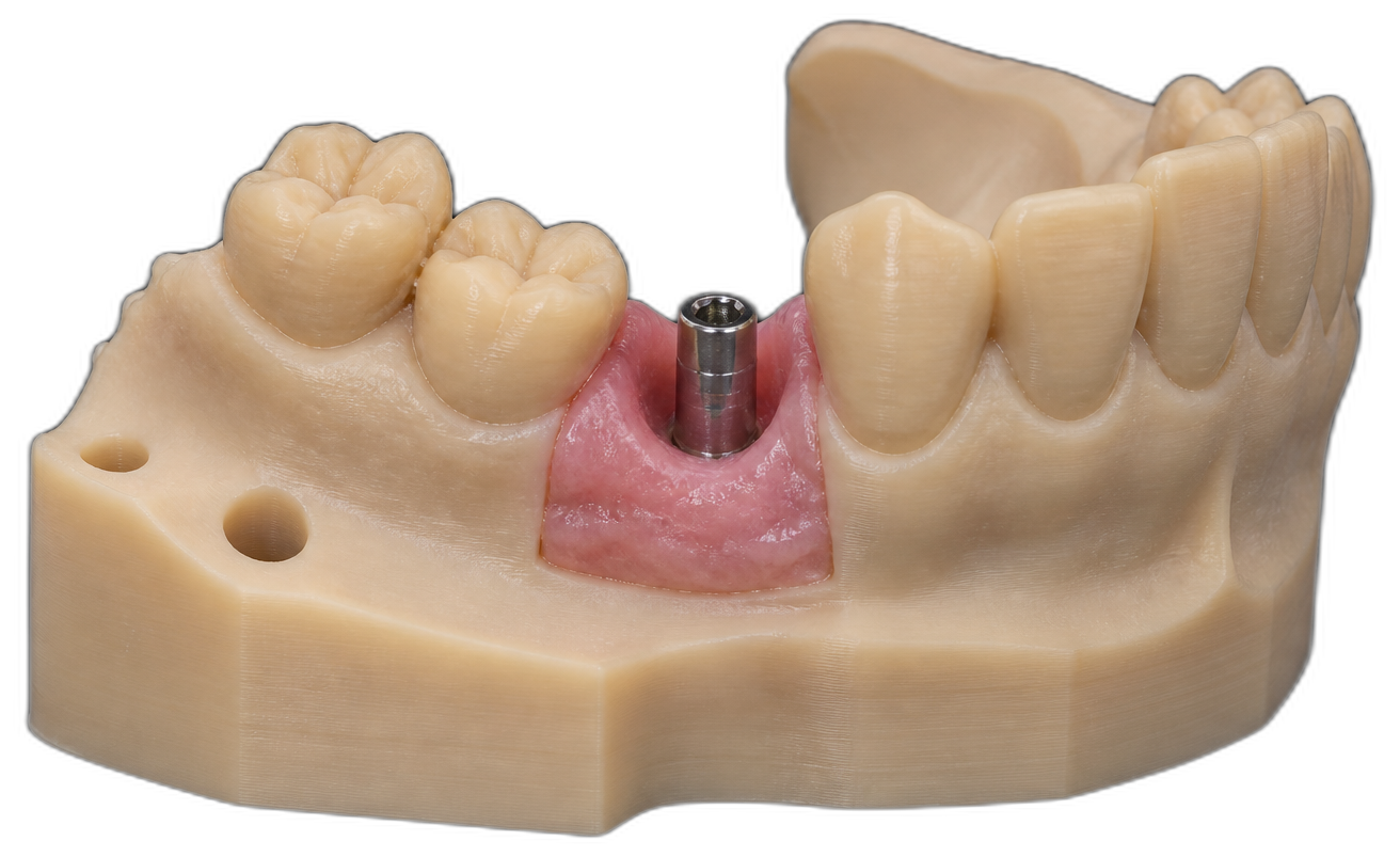 Detailed 3D-printed implant planning model