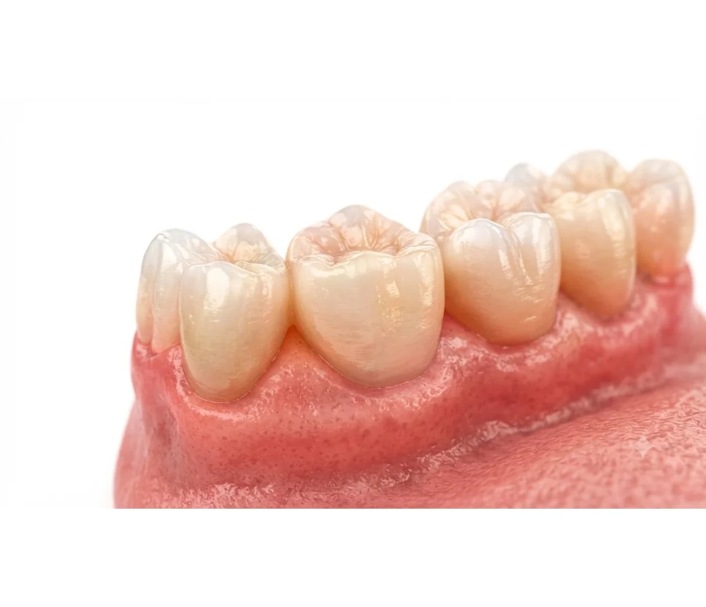 Posterior ceramic crowns seated on pink gingiva against a white background